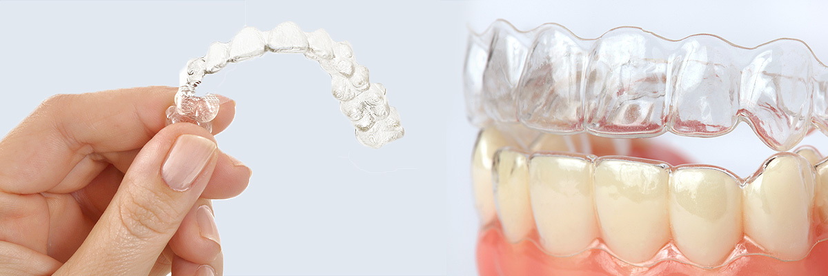 Culver City Alternative to Braces for Teens