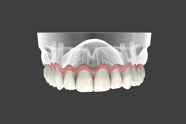 Are Implant Supported Dentures Permanent from Culver City Dental in Culver City, CA