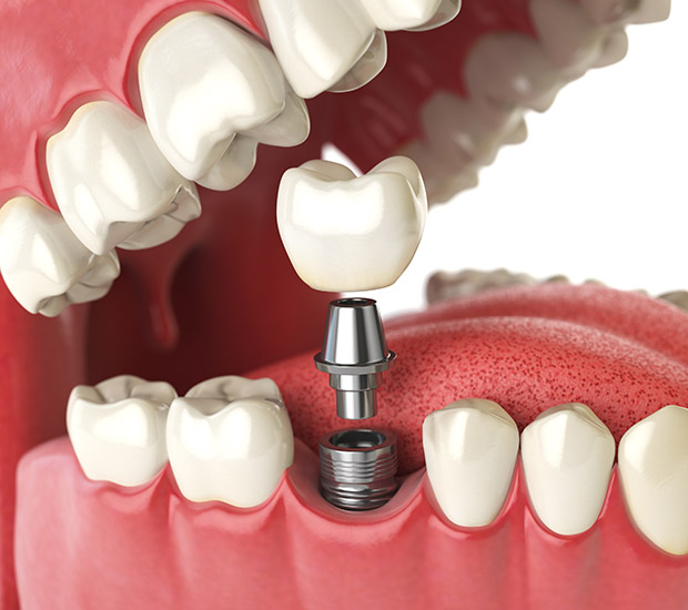 Culver City Will I Need a Bone Graft for Dental Implants
