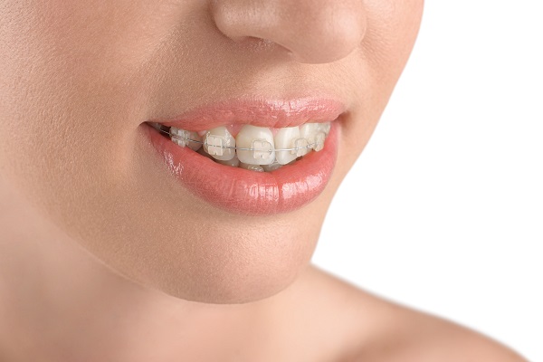 Why You Should Consider Clear Braces