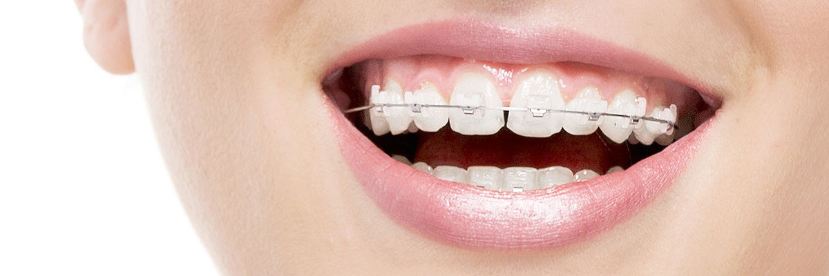 Culver City Invisible Orthodontics
