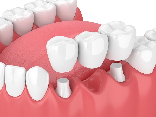 A Guide To   Types Of Dental Bridge