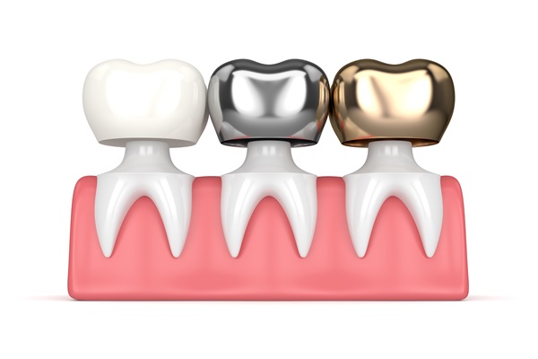 What To Do About A Loose Dental Crown