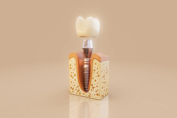Dental Crown Solutions: Strengthening And Protecting Damaged Teeth
