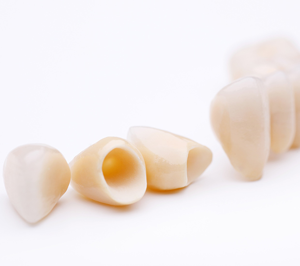 Culver City Dental Crowns and Dental Bridges