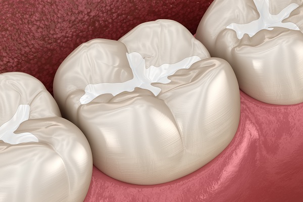 How A Dental Filling Is Used To Treat A Cavity