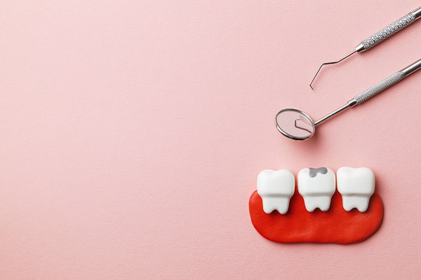 When Should You Get Dental Fillings?