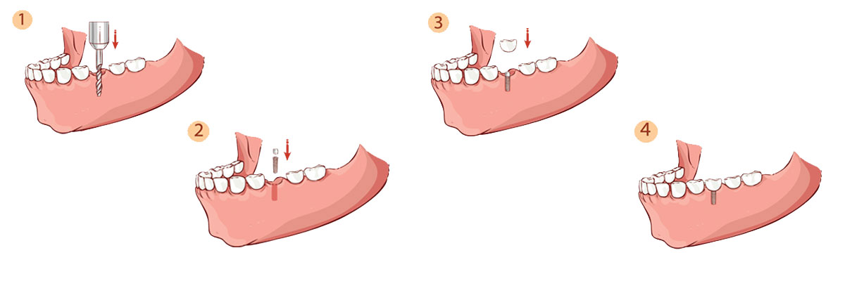 Culver City The Dental Implant Procedure