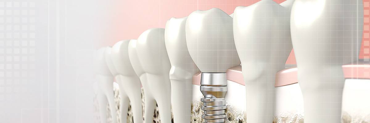 Culver City Dental Prosthetics