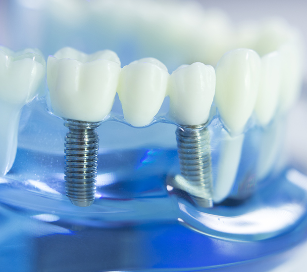 Culver City Dental Implants