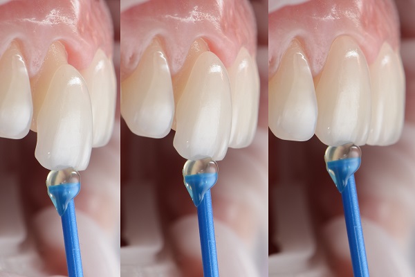 Dental Veneers To Fix A Gap Between Teeth