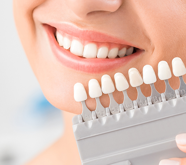 Culver City Dental Veneers and Dental Laminates