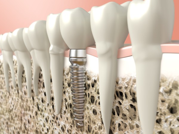 Frequently Asked Questions About Dental Implants