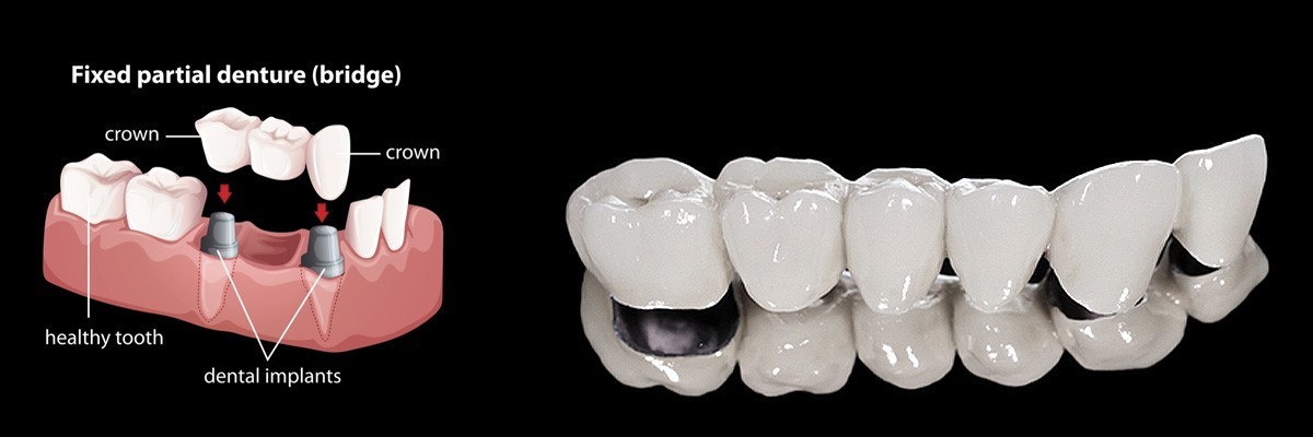 Culver City Dentures