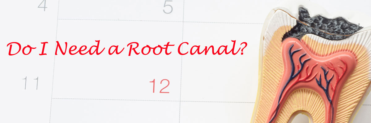 Culver City Do I Need a Root Canal