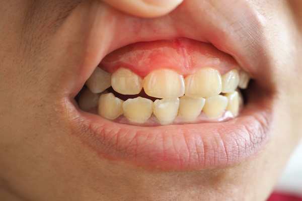 Are Bleeding Gums A Sign Of Gum Disease?