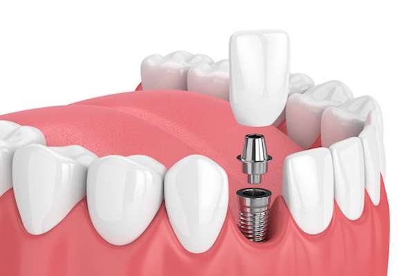 How Painful is Dental Implant Surgery from Culver City Dental in Culver City, CA