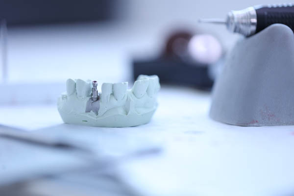 How Successful Is A Dental Implant Restoration?