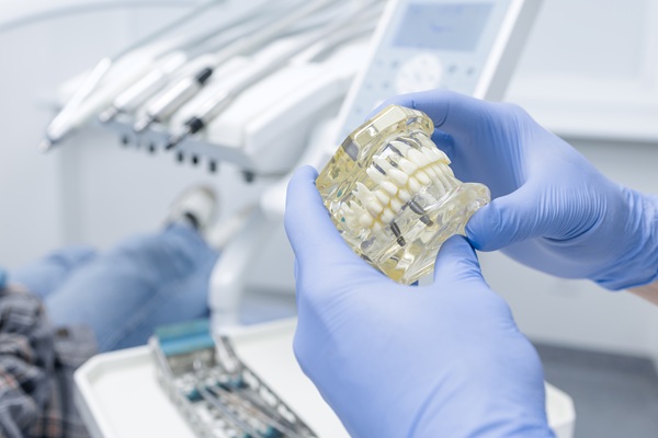 What To Consider When Choosing An Implant Restoration