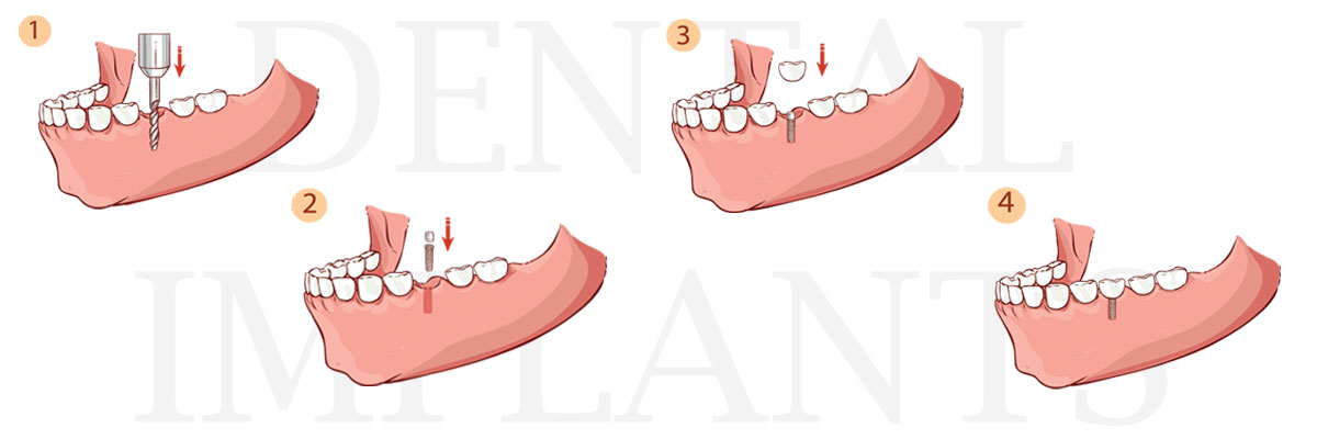 Culver City The Difference Between Dental Implants and Mini Dental Implants