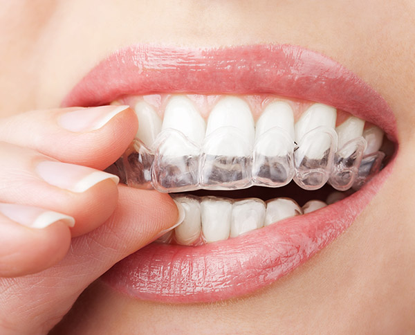 Why You Should Visit An Invisalign® Dentist Office
