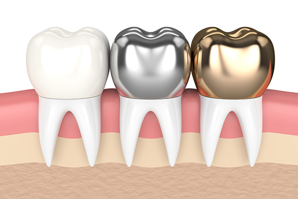 Metal Crowns vs. Porcelain Dental Crowns from Culver City Dental in Culver City, CA