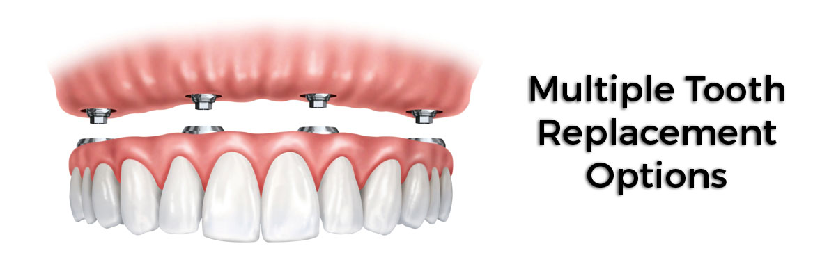 Culver City Multiple Teeth Replacement Options