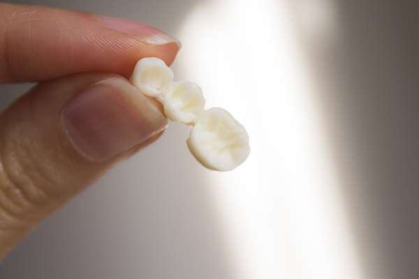 Replace Missing Teeth with Dental Bridges from Culver City Dental in Culver City, CA