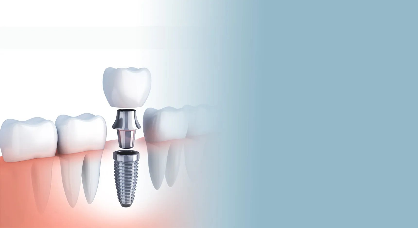 Dental Implants with Abutments and Crowns