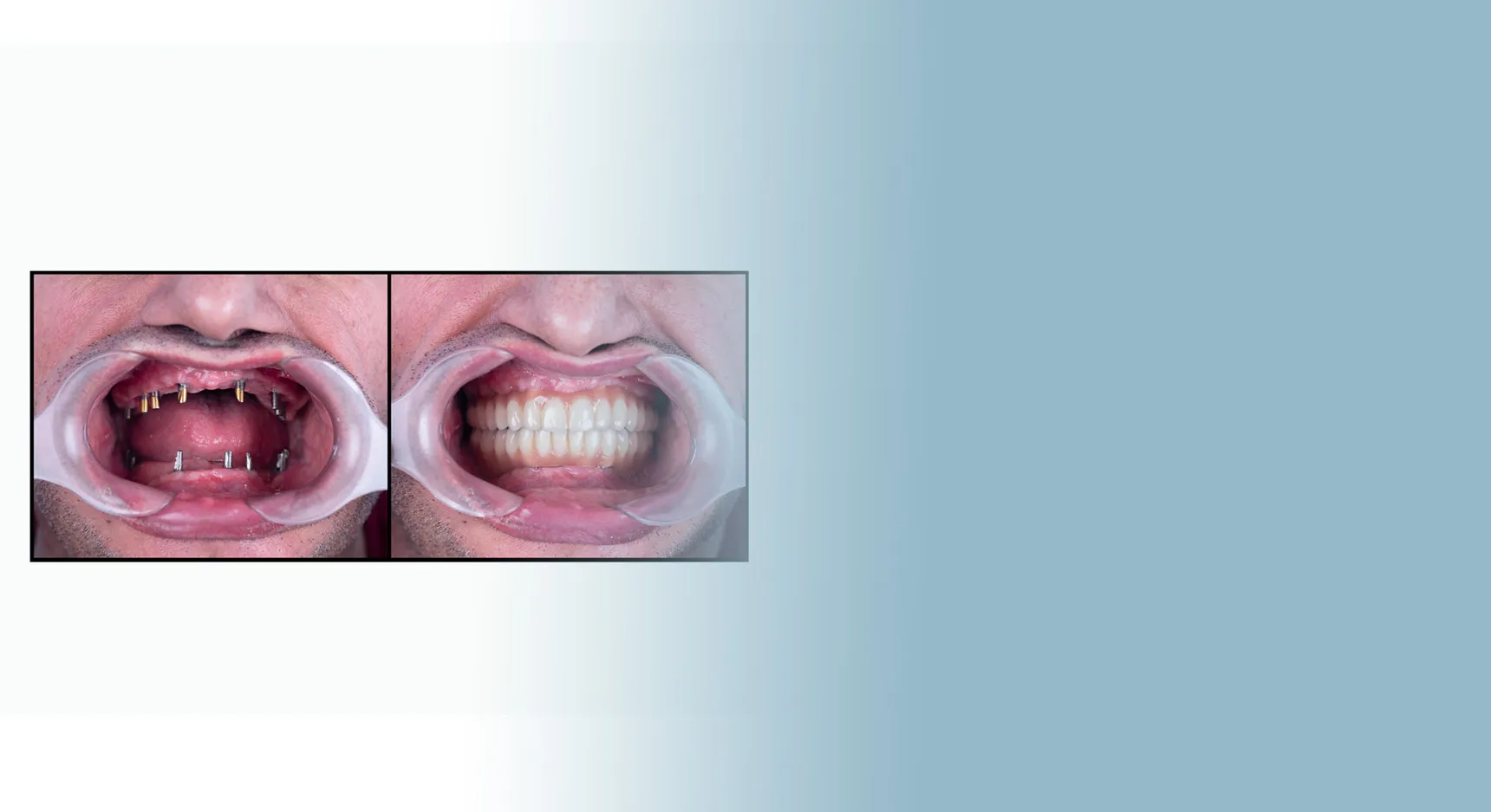 All-On-X Dental Implants