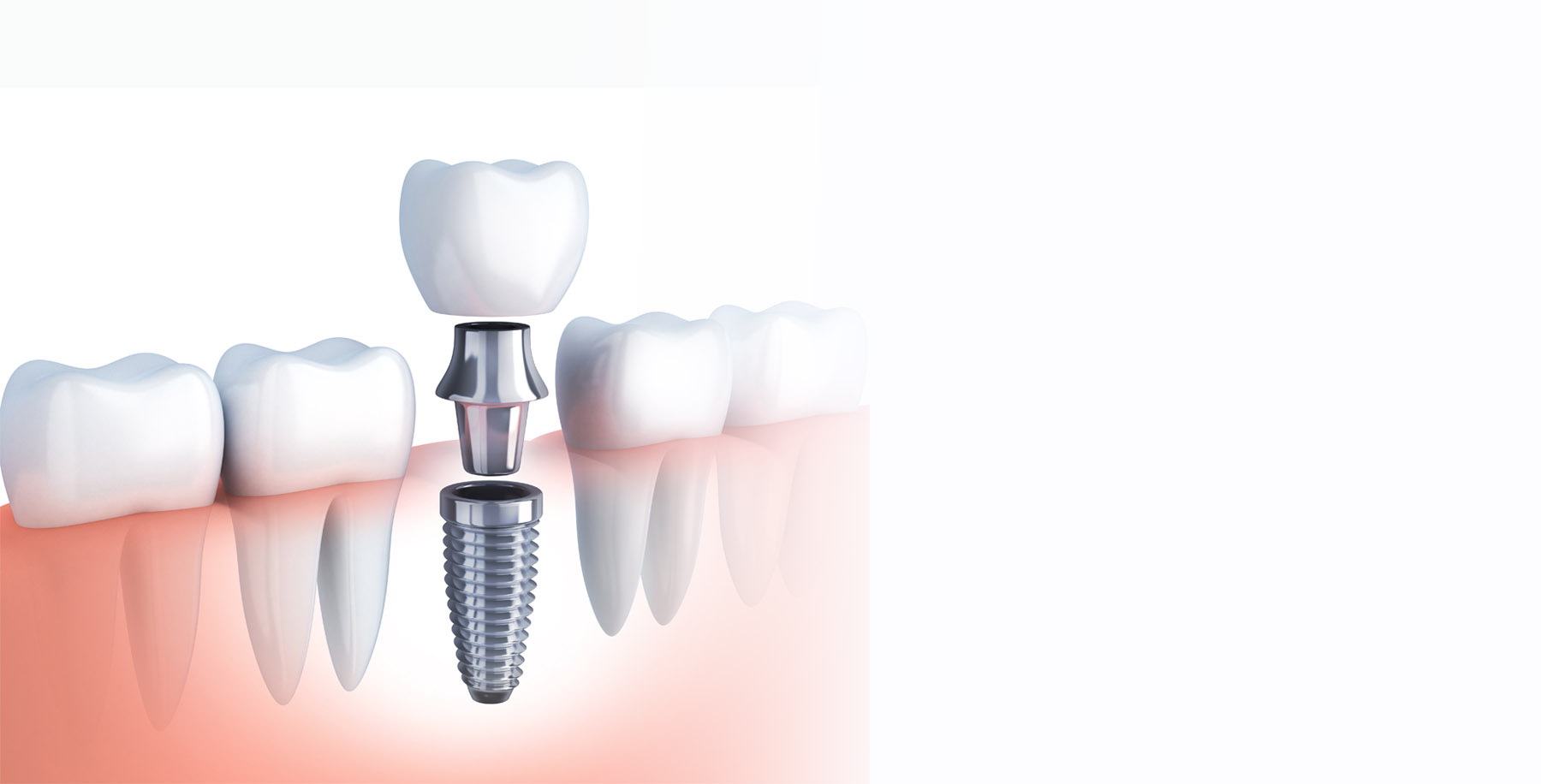 Dental Implants with Abutments and Crowns