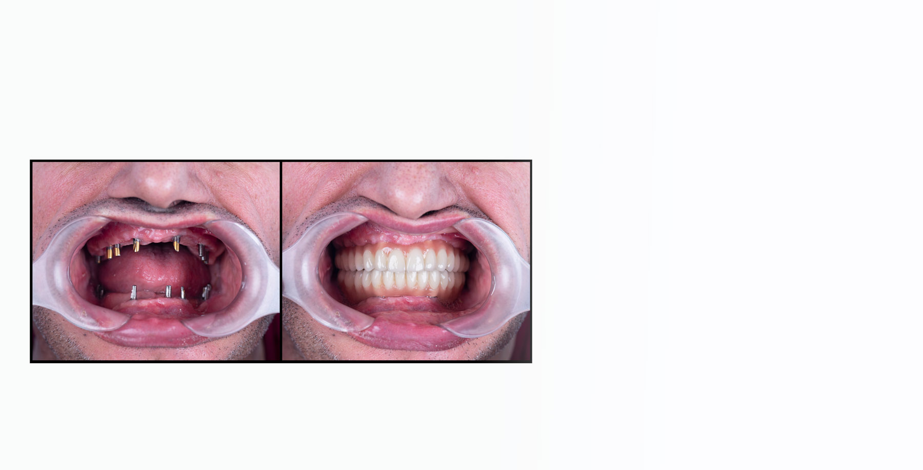 All-On-X Dental Implants