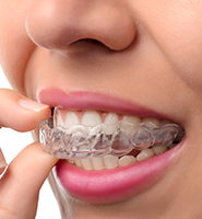 Clear Aligners - Almost Invisible Braces Culver City, CA