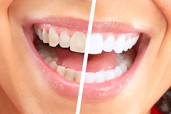 Teeth Whitening Treatment From Your Dentist