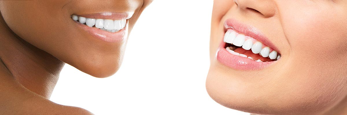 Culver City Teeth Whitening