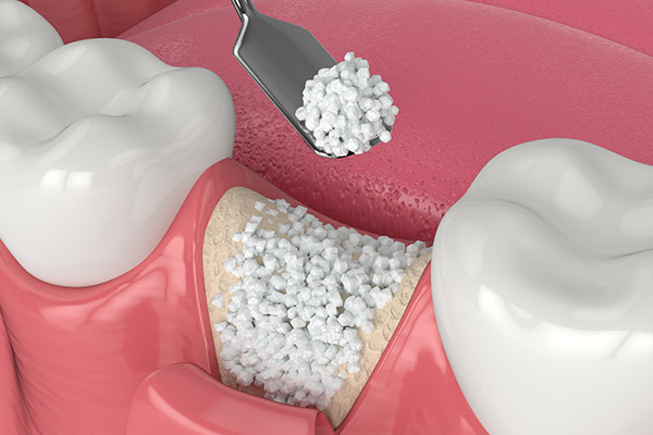 When a Bone Graft Is Needed for an Implant Dentistry Procedure from Culver City Dental in Culver City, CA