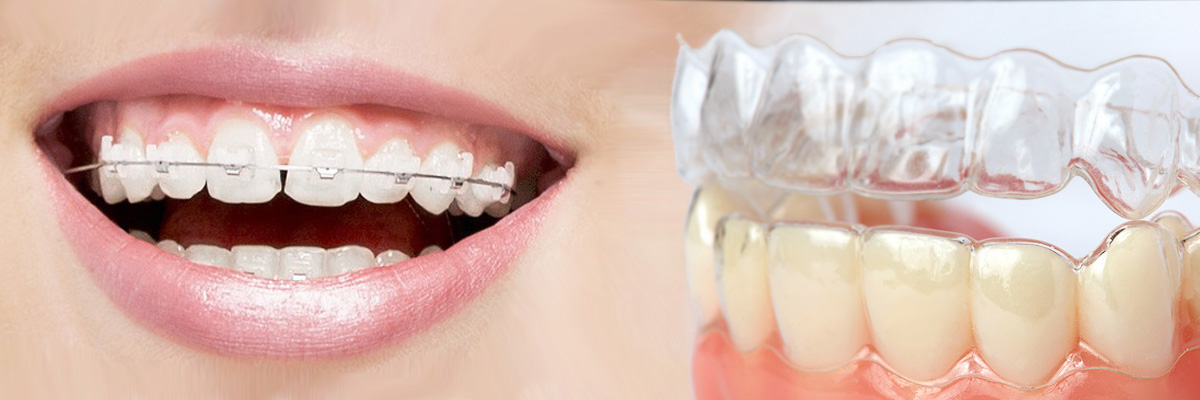 Culver City Which is Better Invisalign or Braces