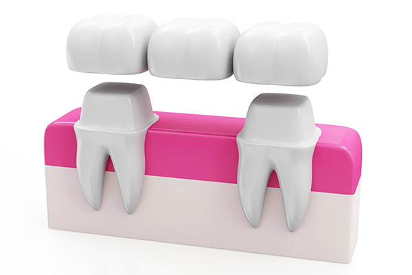 Why Choose A Bridge Option To Replace Missing Teeth