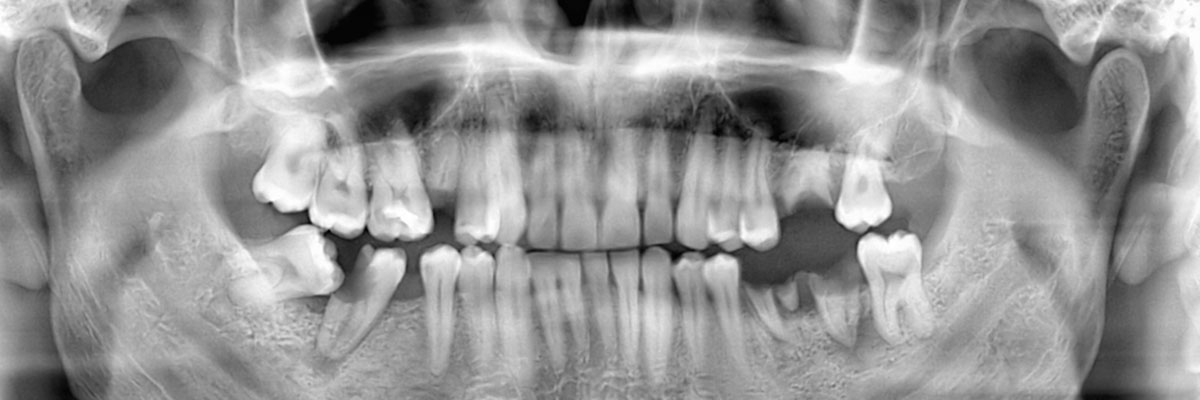 Culver City Wisdom Teeth Extraction
