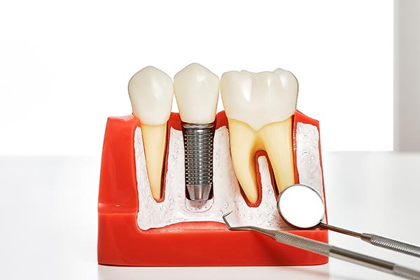 Your Guide to Different Kinds of Dental Implants from Culver City Dental in Culver City, CA